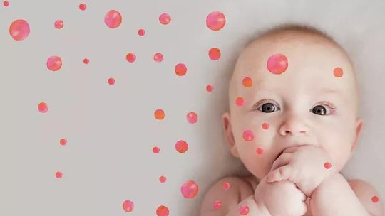 Hemangioma: o que é e o que fazer quando a criança nasce com essa mancha vermelha no corpo?