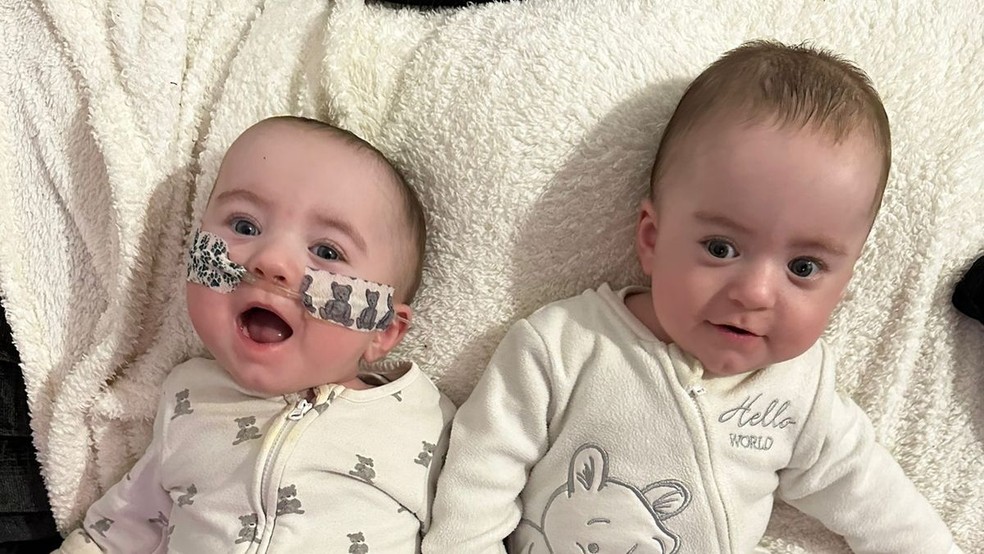 Aos 9 meses, os gêmeos milagrosos estão se desenvolvendo bem — Foto: Reprodução/Mirror