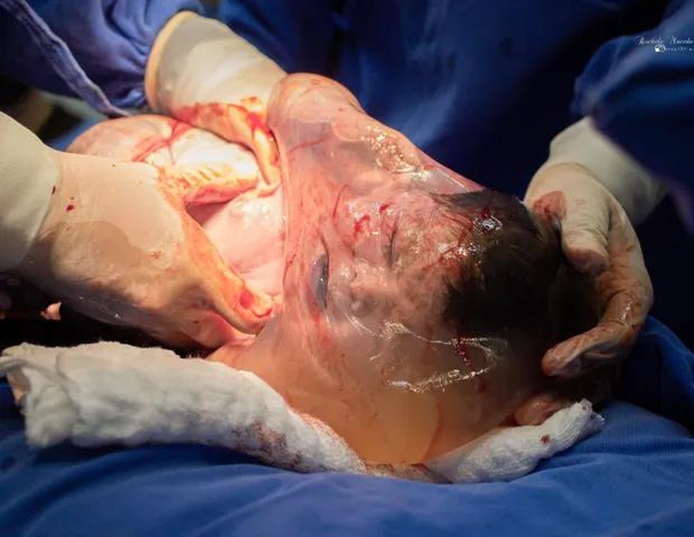 Bebê nasce empelicado no RS (Foto: Rochele Macedo) — Foto: Crescer