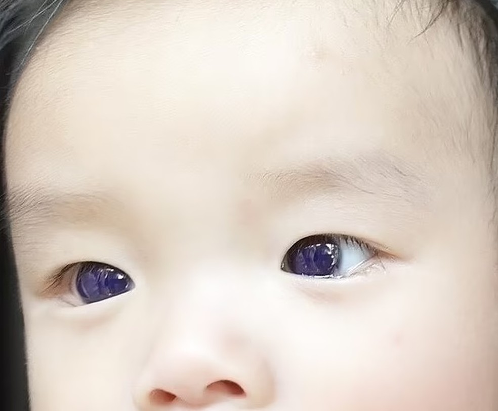 ... e ficaram azuis, depois da medicação — Foto: Reprodução/ Frontiers in Pediatrics