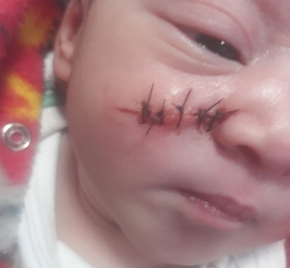 Bebê tem corte no rosto após cesárea  — Foto: Arquivo Pessoal 