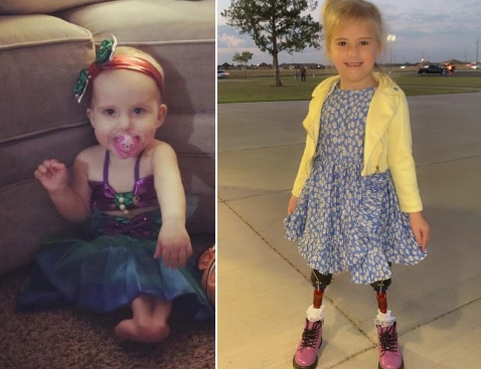 Blaire passou pela amputação e agora aprende a andar com pernas protéticas — Foto: Reprodução/Mirror