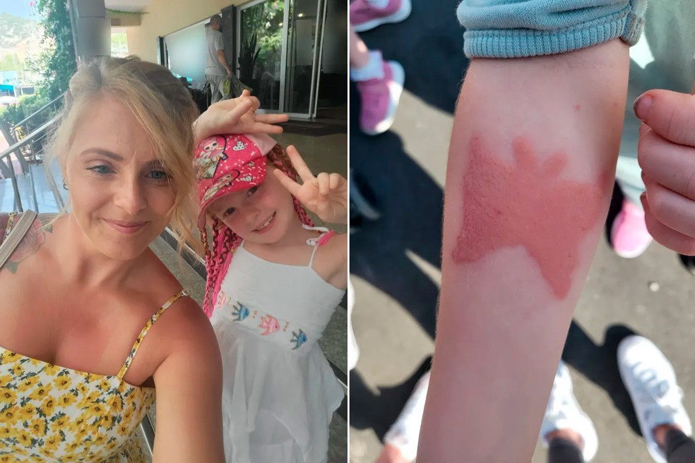 Matilda Newton, de 7 anos, sofreu uma queimadura química após fazer tatuagem de henna — Foto: Reprodução/The Sun