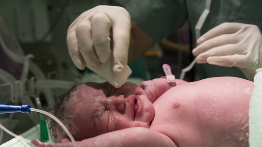 Hipoglicemia neonatal: saiba o que é, sintomas e o que pode provocar a condição em recém-nascidos