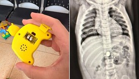 Mãe de SP faz alerta após bebê engolir pilha botão: "Cada minuto conta"