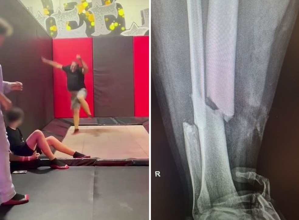 Ryan quebrou a perna e precisou de cirurgia para colocação de uma haste de metal — Foto: Reprodução/The Mirror