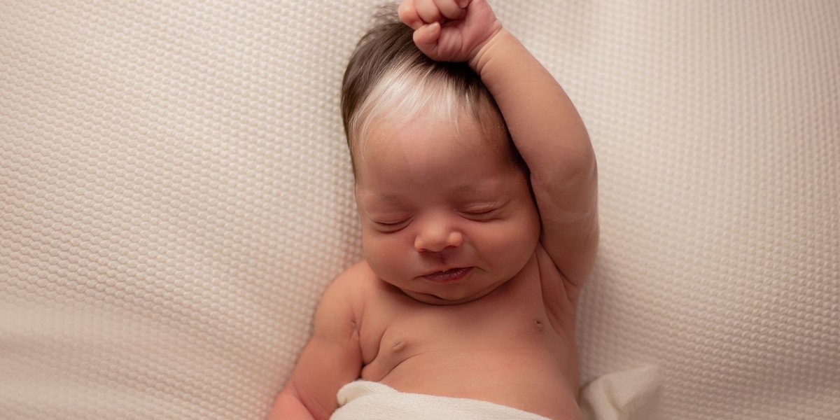 Bebê com condição genética faz sucesso na web