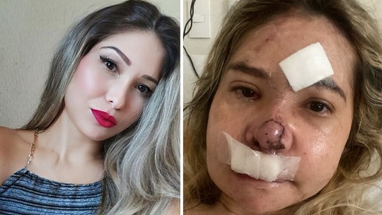 Paraense foca em reconstrução facial após acidente: "Lutando pra ter meu rosto de volta"