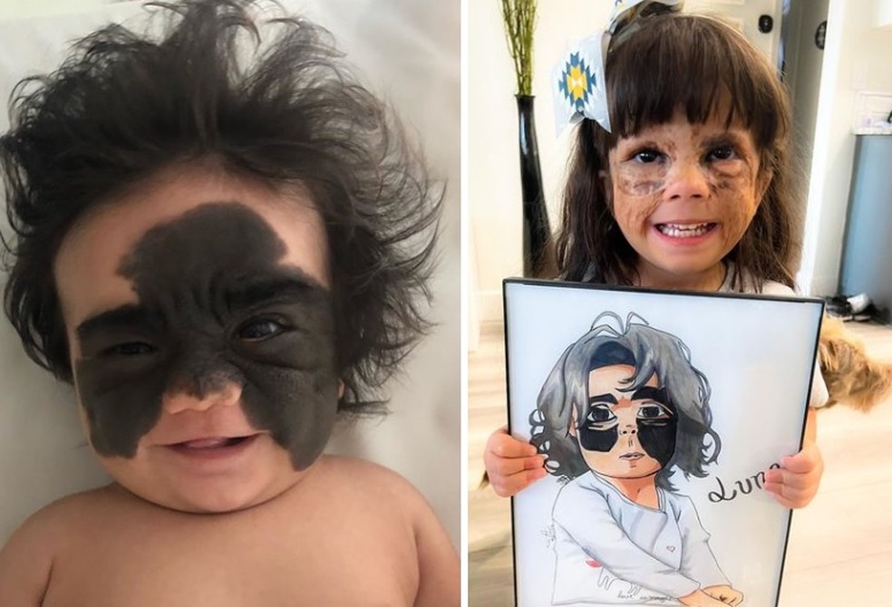 À esquerda, Luna bebê, antes do tratamento e, à direita, recentemente, com 4 anos  — Foto: Reprodução Instagram
