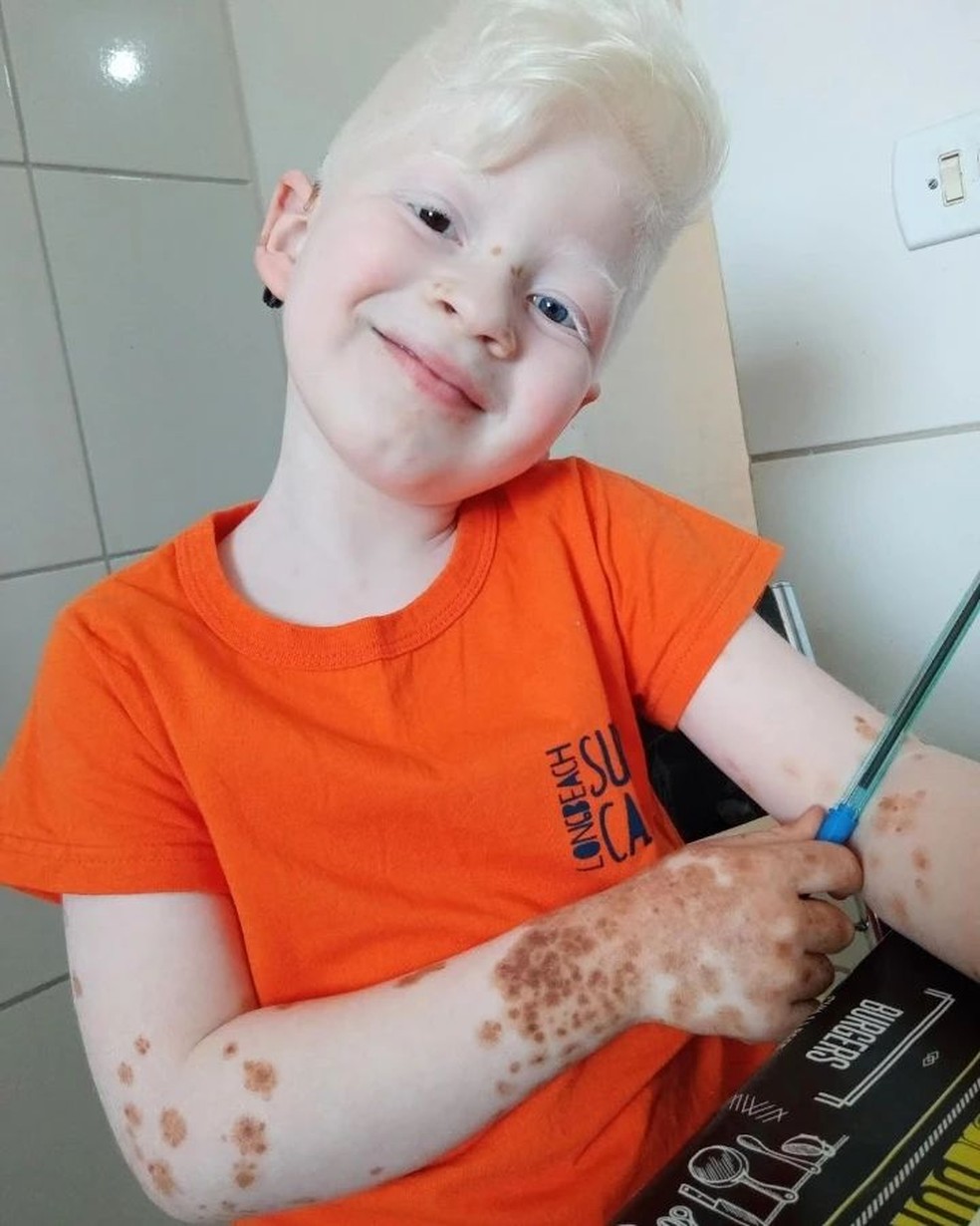 Por causa da síndrome, Ryan também tem manchinhas marrons na pele — Foto: Reprodução/Instagram