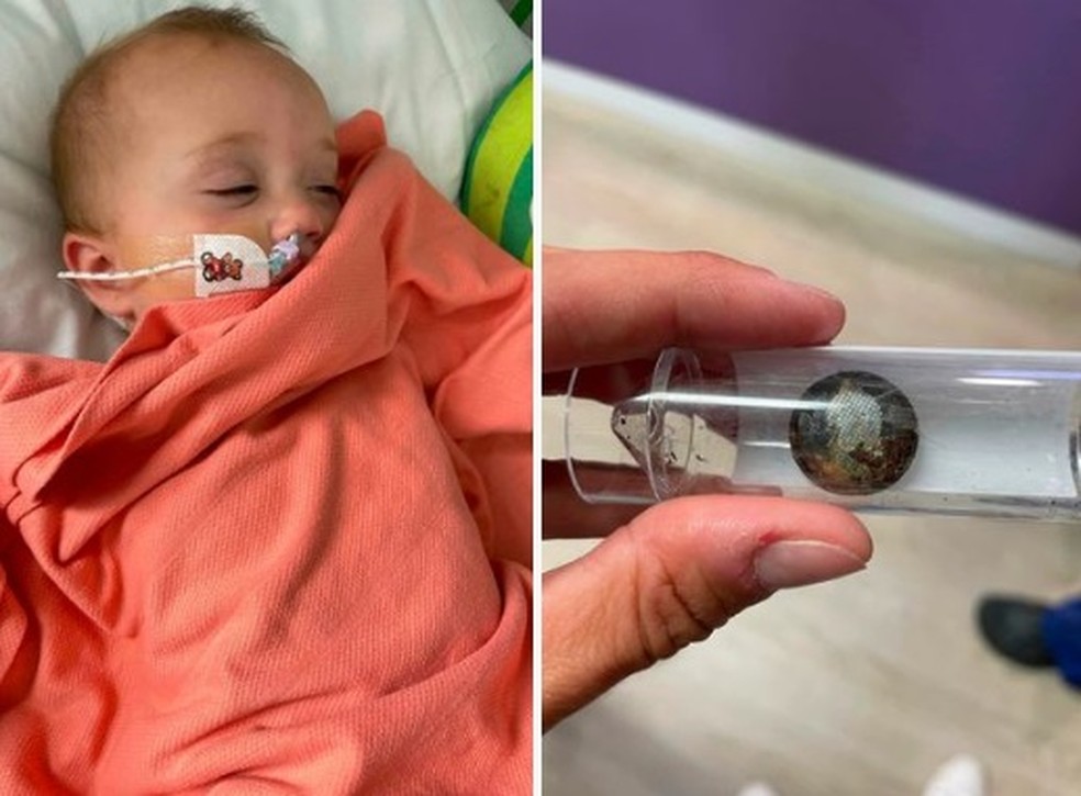 Bebê engoliu bateria de botão, do tamanho de uma moeda — Foto: Reprodução/Mirror