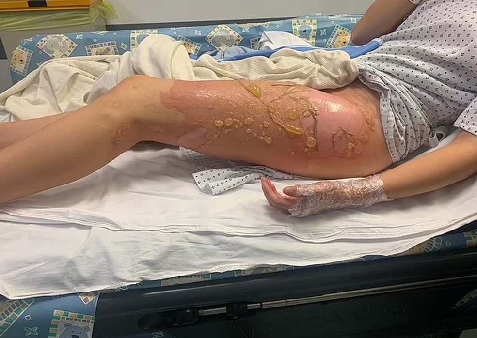 A pele de Sydney teve queimaduras graves — Foto: Reprodução/ Daily Mail