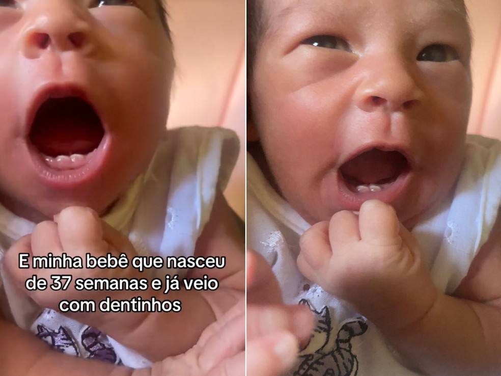 Bebê surpreende ao nascer com dois dentinhos, em MS. Entenda