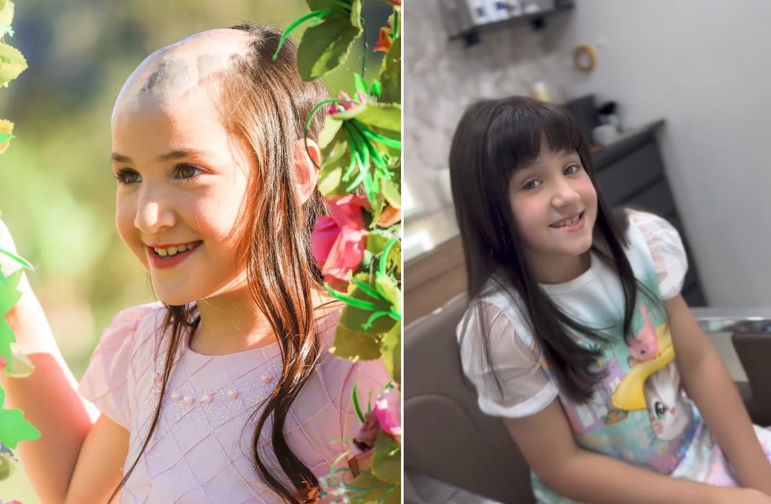 Menina que perdeu os cabelos após acidente com óleo quente usa as redes ...