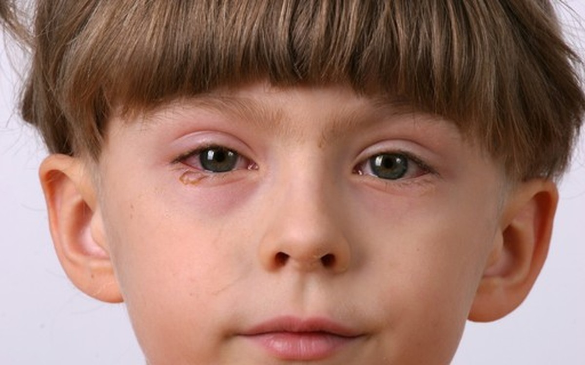 Terçol ou conjuntivite? Saiba diferenciar alergias e inflamações na ...