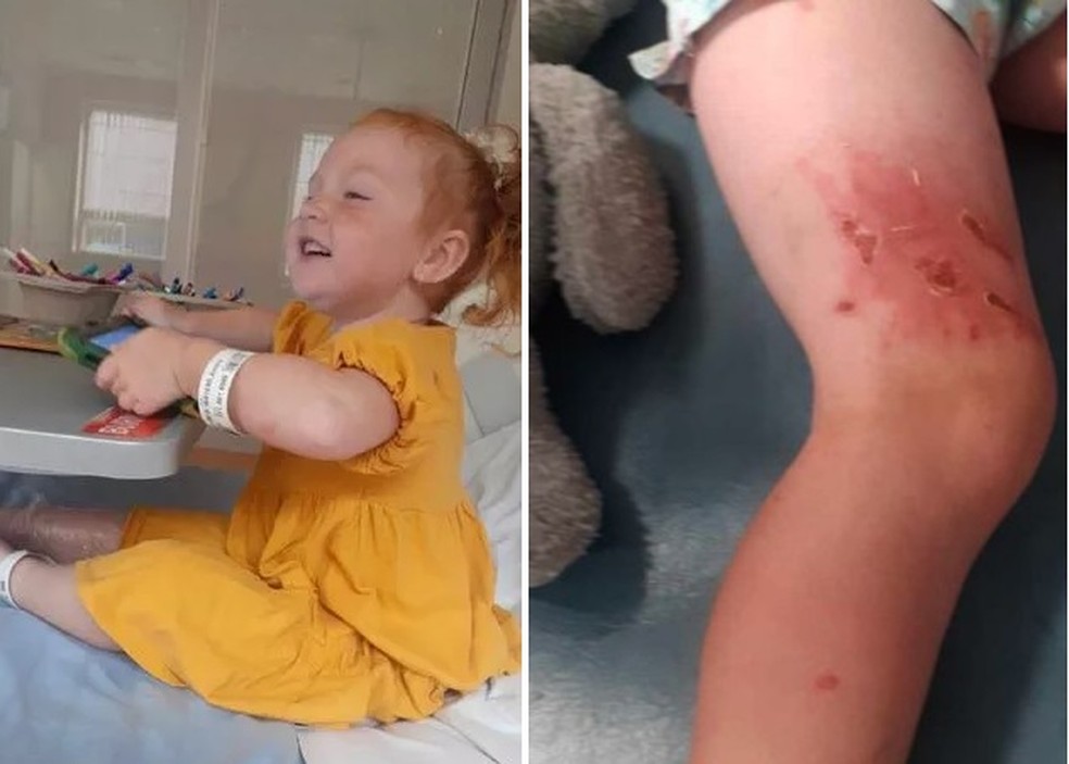 A menina sofreu queimaduras severas depois de ter contato com planta perigosa — Foto: Reprodução/ Daily Mail
