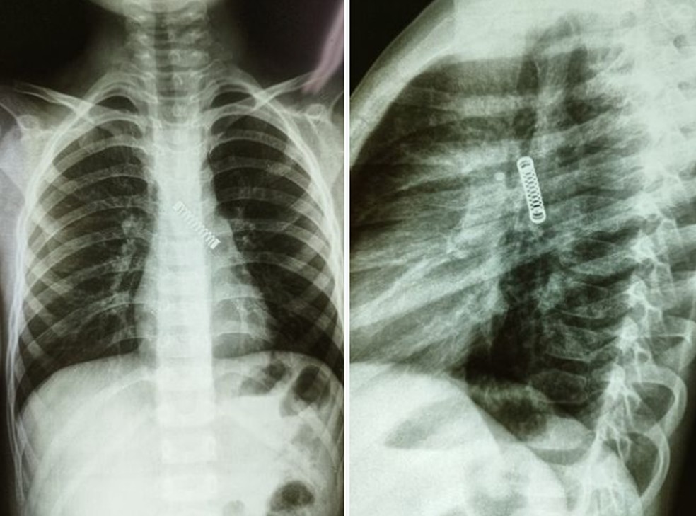 Mola em pulmão de menino de 5 anos — Foto: Reprodução/The Mirror