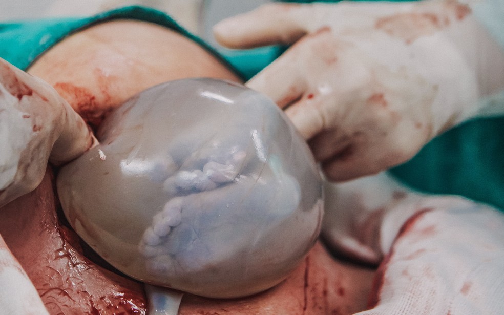Bebê nasce empelicado e pélvico — Foto: @brunacostafotografias