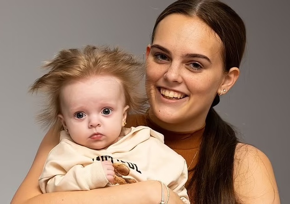 A pequena pode ter a síndrome do cabelo impenteável e chama a atenção por onde passa — Foto: Reprodução/ Daily Mail