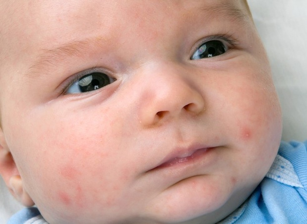 Bebê pode ter acne neonatal no rosto (Foto: Thinkstock) — Foto: Crescer