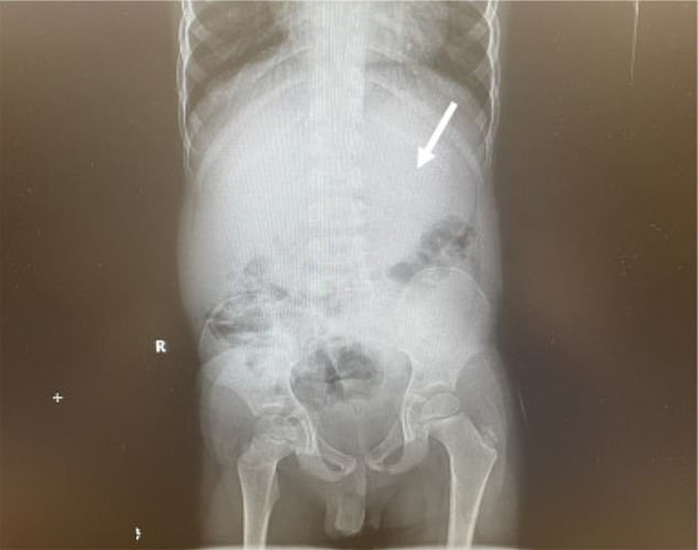 Criança engoliu mais de 40 gomas de mascar — Foto: sciencedirect.com