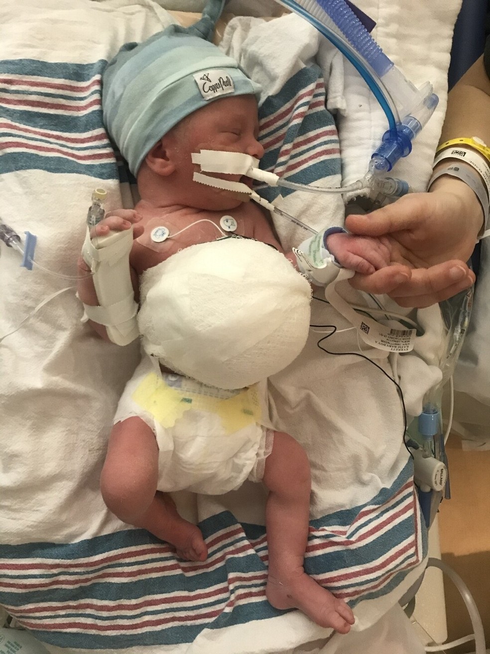 Ainda durante a gravidez, o bebê foi diagnosticado com uma condição rara, chamada onfalocele: seus órgãos se desenvolvaram do lado de fora do corpo — Foto: Reprodução/ Fox News