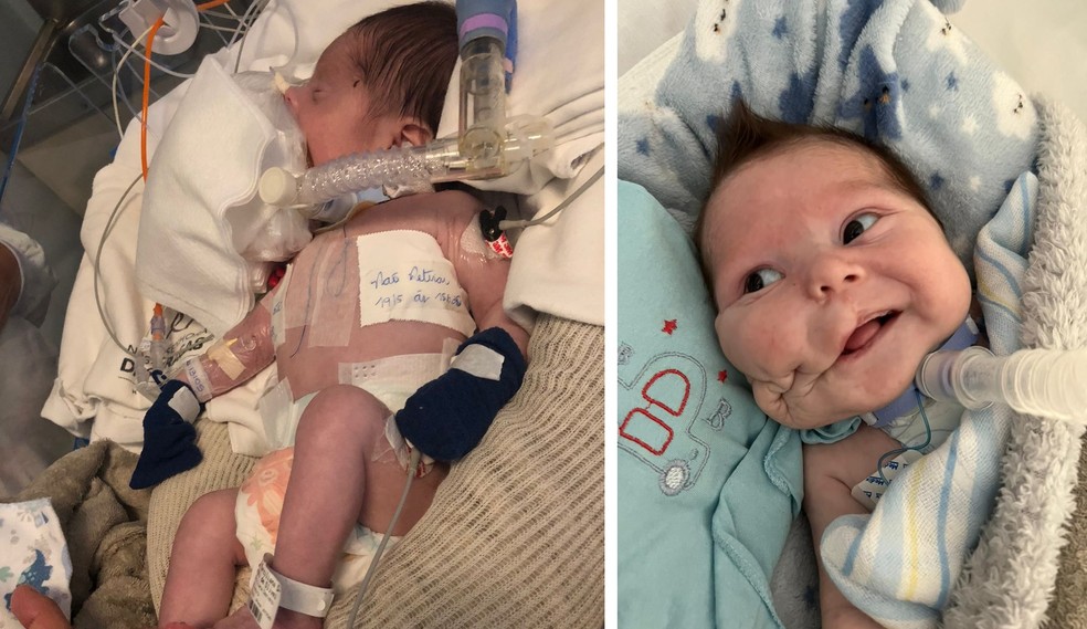 Braian antes de depois da cirurgia — Foto: Arquivo pessoal