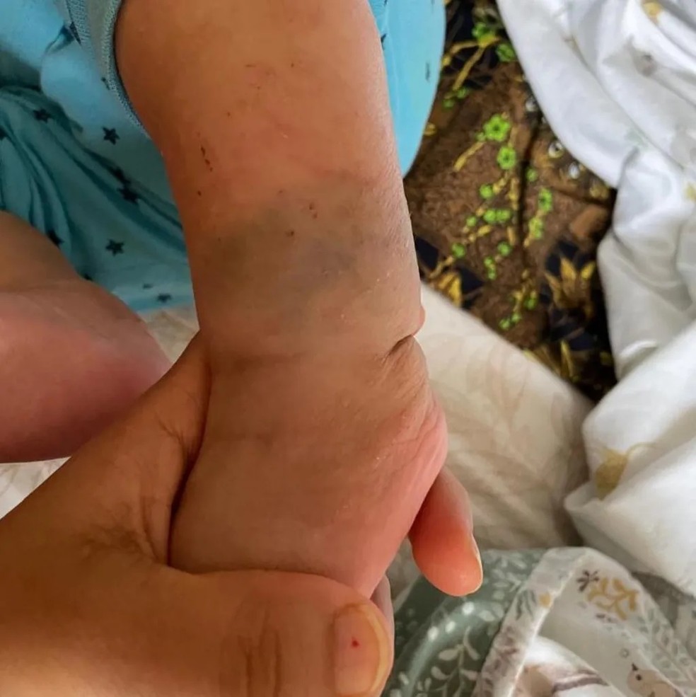 Marca de nascença de bebê é confundida com hematoma e mãe é presa