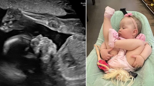 Bebê viraliza com posição antes e depois do nascimento: "Mania continua", diz mãe