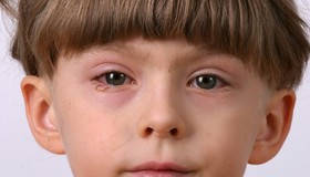 Terçol ou conjuntivite? Como diferenciar alergia e inflamação nos olhos
