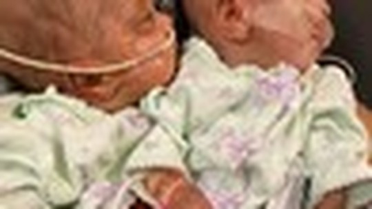 Gêmeas que nasceram com 22 semanas surpreendem médicos quatro meses depois