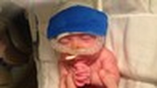 Bebês prematuros: "Minha filha nasceu com apgar 0 no primeiro minuto de vida"