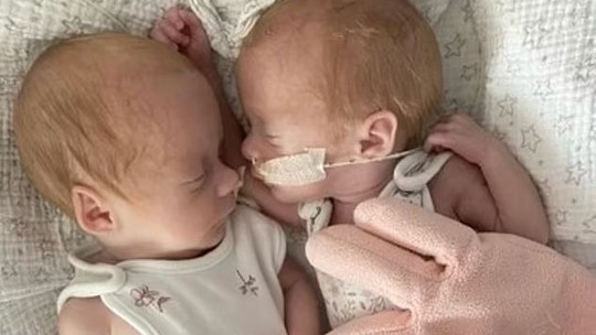 Irmãs gêmeas que tinham menos de 10% de chance de sobreviver comemoram primeiro aniversário