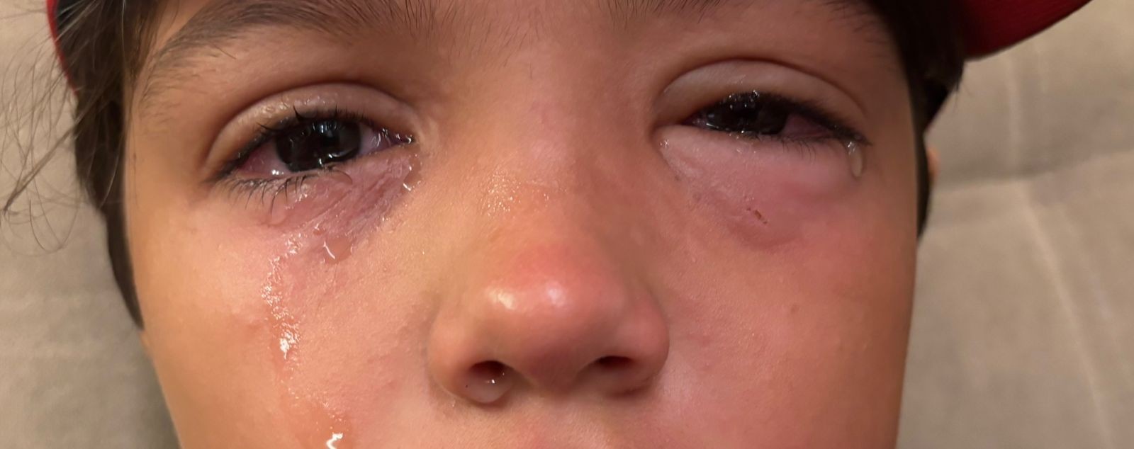 Menino sofre lesão nas córneas após brincar em piscina sem óculos de proteo