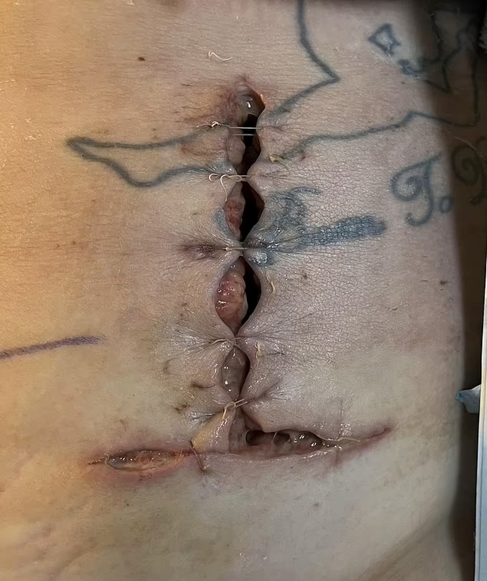 Uma das cicatrizes de Charleigh  depois da cirurgia — Foto: Arquivo pessoal