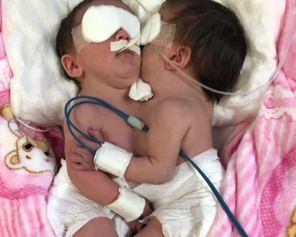 Gêmeas nasceram unidas do tórax ao umbigo — Foto: Arquivo pessoal