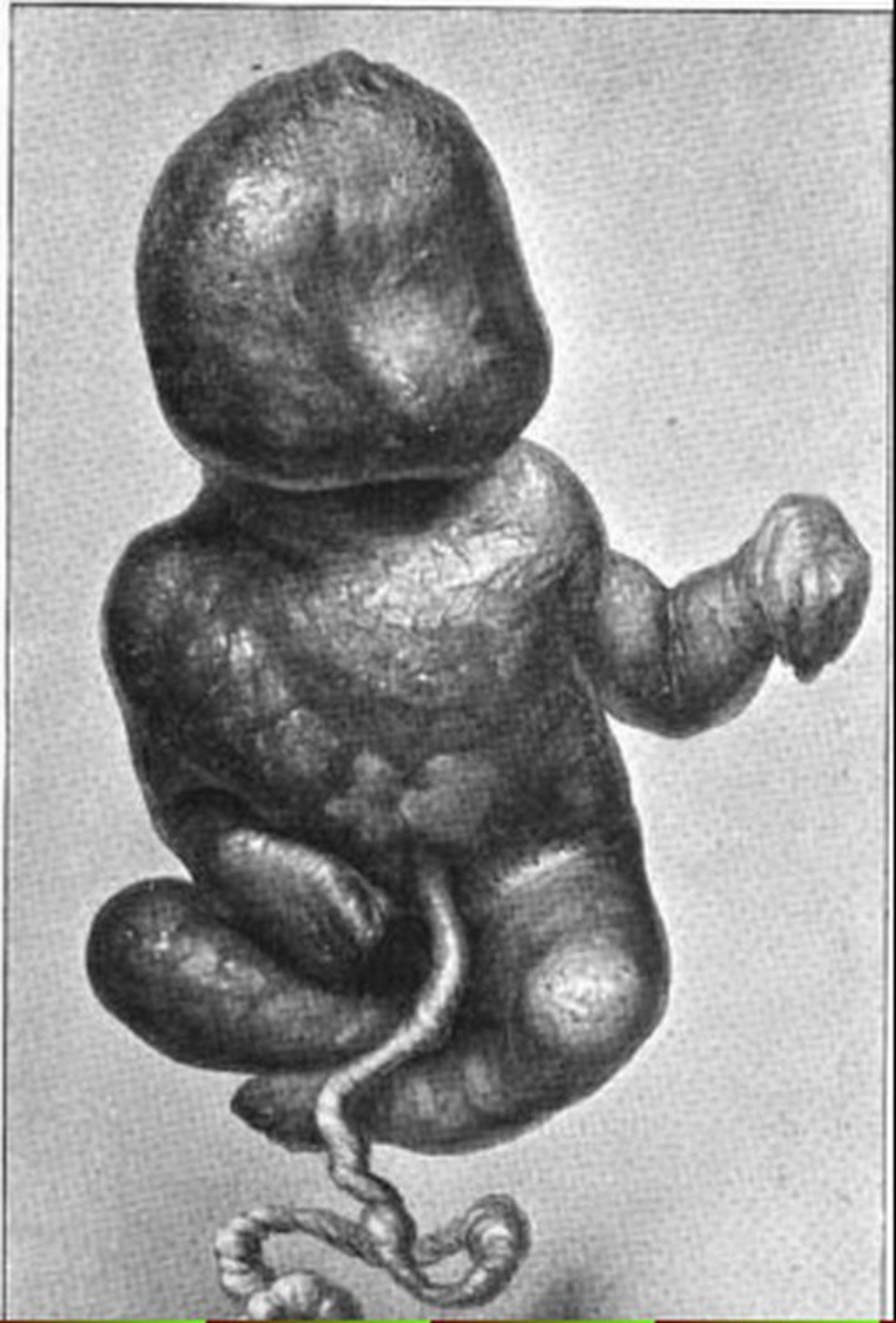 Exemplo de litopedia, caso raro em que feto se mumifica dentro da barriga da mulher — Foto: Wikimedia Commons