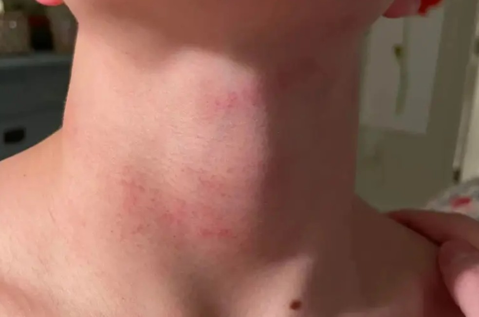 Estudante ficou com marcas e hematomas no pescoço — Foto: Reprodução/Youtube